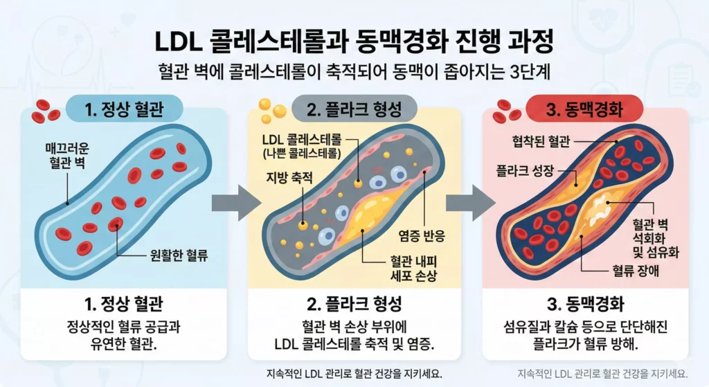 LDL 콜레스테롤 구조와 동맥경화 진행 과정 인포그래픽