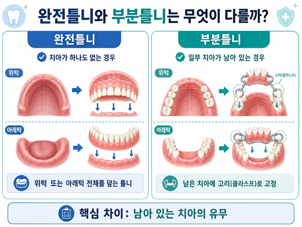 완전틀니 부분틀니 차이 설명 이미지